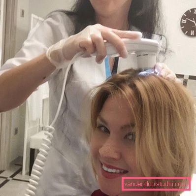 causa di perdita di capelli nelle donne dopo i 40 anni