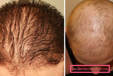 fase di alopecia fase di alopecia