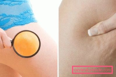 cellulite sui fianchi cellulite sui fianchi
