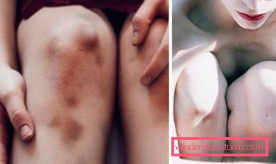 gambe contuse gambe contuse