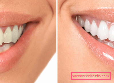 denti prima e dopo una sessione con flusso d'aria denti prima e dopo una sessione con flusso d'aria