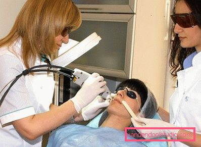 depilazione laser depilazione laser