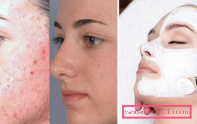 pelle perfetta dopo peeling chimico pelle perfetta dopo peeling chimico