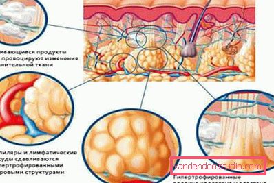 cellulite