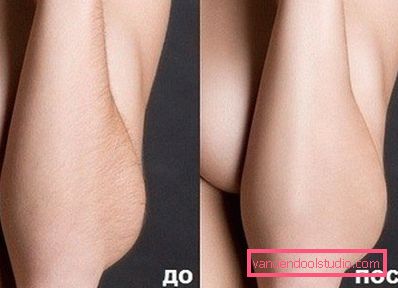 avambraccio femminile prima e dopo il rimedio avambraccio femminile prima e dopo il rimedio