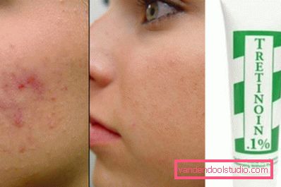eliminazione di acne