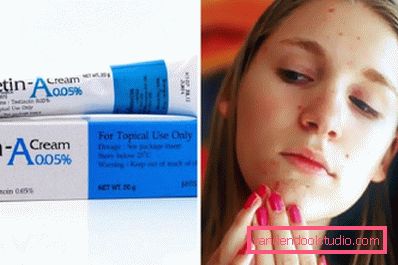 sbarazzarsi di acne