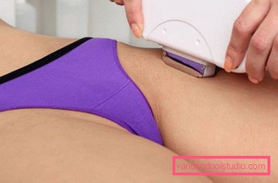 depilazione laser depilazione laser