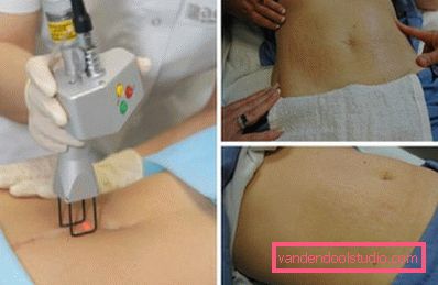 244-Laser peeling duro