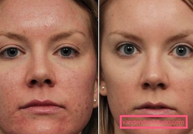 effetto prima e dopo peeling con un raggio laser effetto prima e dopo peeling con un raggio laser