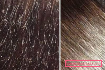 recupero dei capelli recupero dei capelli