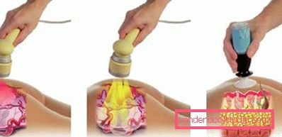 mesoterapia ad ultrasuoni mesoterapia ad ultrasuoni