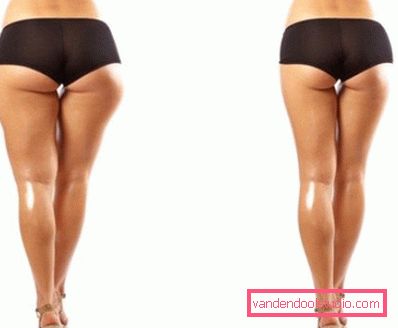 prima e dopo la correzione delle fistole per mesoteropia prima e dopo la correzione delle fistole per mesoteropia