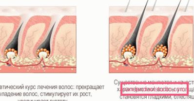 Mesoterapia dei capelli