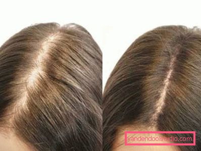 Mesoterapia dei capelli