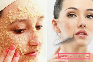 sbarazzarsi di acne con i fiocchi sbarazzarsi di acne con i fiocchi