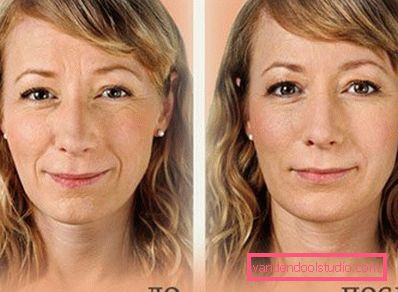 prima e dopo l'ozono facciale prima e dopo l'ozono facciale