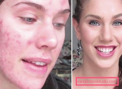 prima e dopo la rimozione dell'acne prima e dopo la rimozione dell'acne