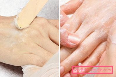 terapia alla paraffina fredda terapia alla paraffina fredda