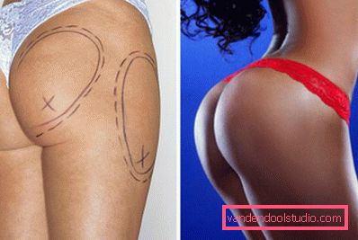 lipofilling lipofilling