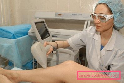 depilazione laser depilazione laser