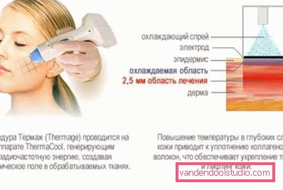Thermage Thermage