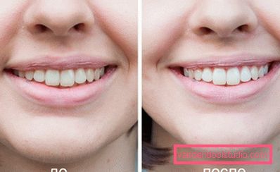 zoomare foto prima e dopo zoomare foto prima e dopo